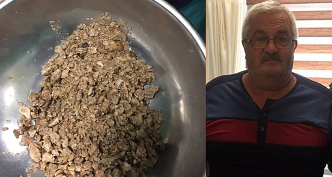 Bu taşlar böbreğinden çıktı