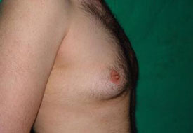 Erkeklerde meme büyüklüğü sorunu