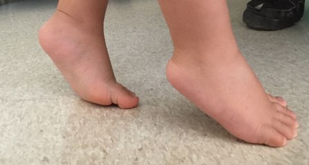 Çocuğunuz parmakları üzerinde yürüyorsa dikkat edin!