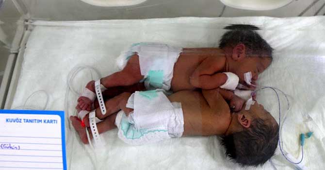 Gazze'de yapışık ikiz dünyaya geldi