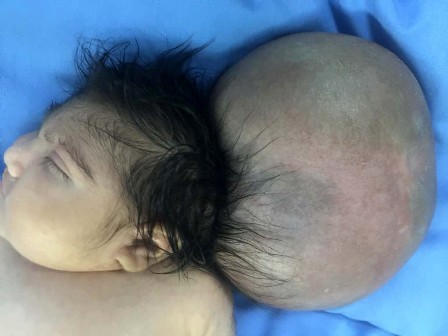 Kafasından büyük kafatası ile dünyaya gelen bebek sağlığına kavuştu