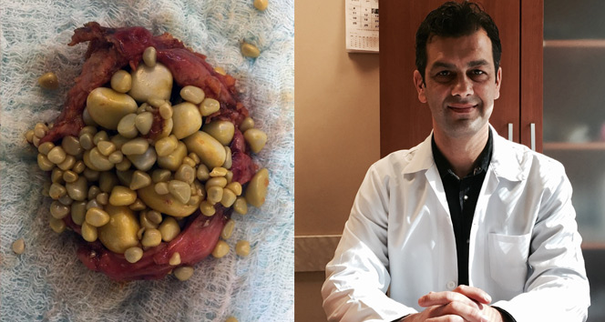 Karın ağrısı şikayetiyle gitti, safra kesesinden bunlar çıktı