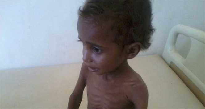 Yemenli çocukların yüzde 80’i insanı yardıma muhtaç
