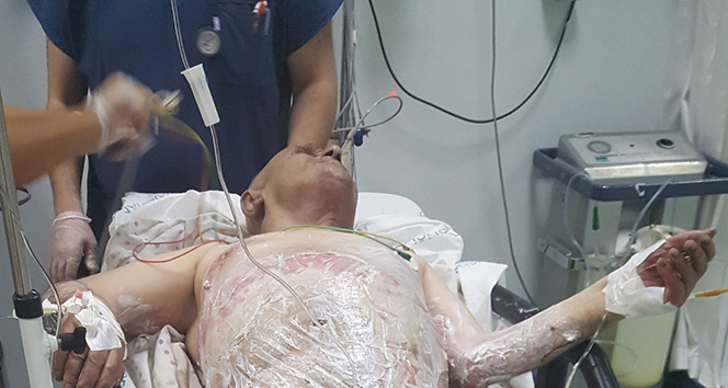 Sigaradan elbiseleri tutuştu, yanarak ağır yaralandı