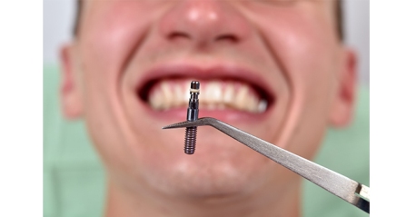 Yetersiz hijyen implant kaybına yol açabilir