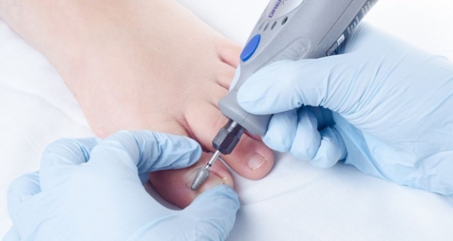 Tırnak batmasında uygulanan yanlış yöntemlere dikkat