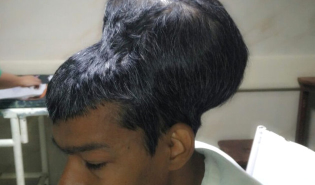 Şimdiye kadar görülen en büyük beyin tümörü!