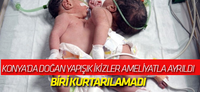 Konya'da Doğan Yapışık İkizler Ameliyatla Ayrıldı, Biri Kurtarılamadı