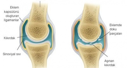 Osteoartrit (Kireçlenme), yaşam kalitenizi düşürmesin