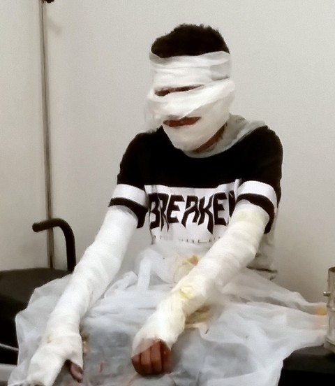 Torpil patlatan çocuklar hastanelik oldu