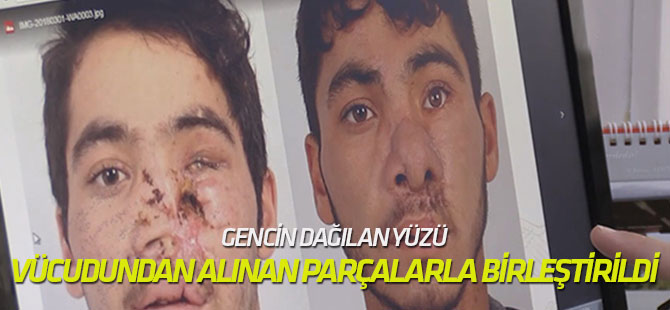 Dağılan yüzü, vücudundan alınan parçalarla birleştirildi
