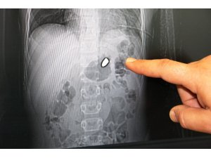 Arda’nın vücudundan 20 milimetrelik serseri kurşun çıkarıldı
