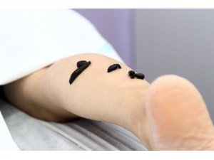 Doktorların elinden sülük tedavisi