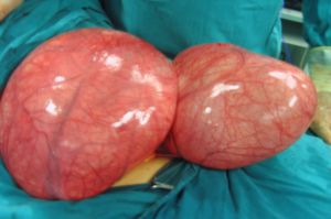 Futbol topu gibi kist çıktı