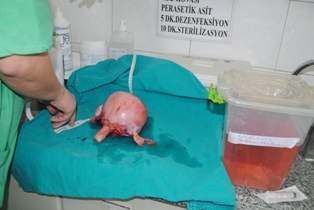 Hastanın rahminden 1.5 kilo kitle çıkarıldı