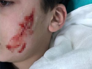 6. sınıf öğrencisi kalemtıraş bıçağıyla arkadaşının yüzünü kesti