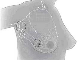 Meme kanseri tümörleri yok edildi