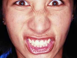 Soğuk hava yüz felcini tetikliyor