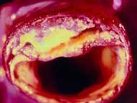 Atardamarlar üç boyutlu izlenebilecek