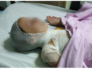 Kaynatılırken taşan süt çocuğu hastanelik etti