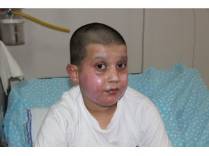 Sprey kutusu patladı, küçük çocuğun yüzü feci şekilde yandı