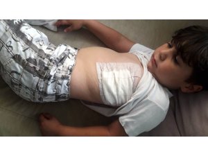 Fatsa’da köpeğin saldırısına uğrayan çocuk yaralandı