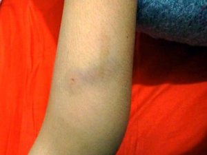 Fatsa’da köpeğin saldırısına uğrayan çocuk yaralandı