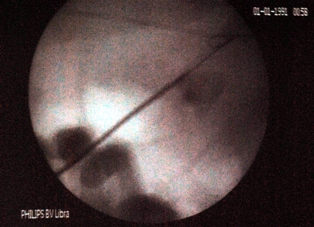 Böbrek taşının oluşumu önlenebilir mi?