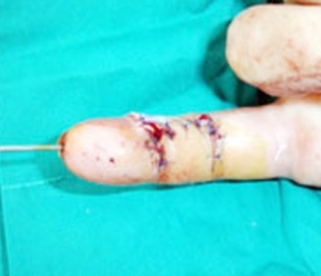 Parmak kopmalarında yapılması gerekenler