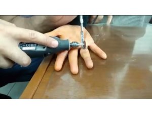 Parmağındaki yüzüğü çıkartamayan kadının imdadına AFAD yetişti