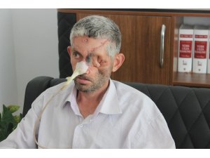 Gözünü kanserden kaybetmiş