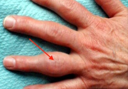 En sık görülen eklem hastalığı