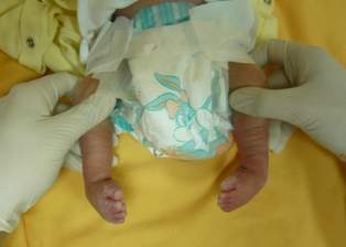 Bebeklerde çarpık ayaklara alçılı tedavi