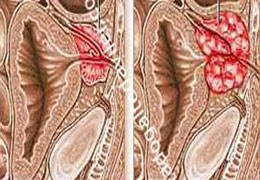 Erkeklerin korkulu rüyası prostat