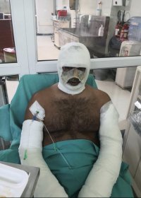 Kebapçıda fırın patladı, iş yeri sahibi ağır yaralandı