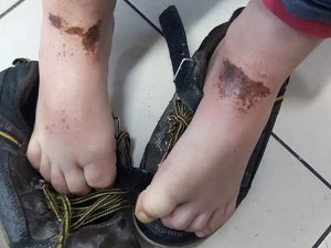 Okul bahçesinde oynayan öğrencilerin vücutlarında oluşan çürük ve yanıklar sağlık kuruluşları ile Belediyeyi harekete geçirdi