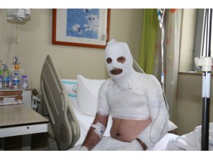 Tinerle temizlik yaparken sigara yakınca kıyafeti alev aldı