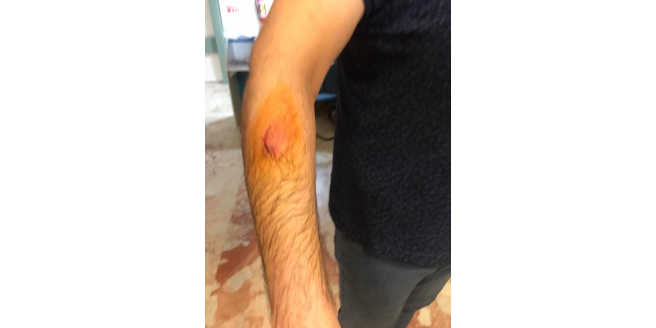 Hasta yakını, sağlık çalışanını ısırıp, darp etti