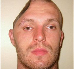 Eksik kafatasıyla yaşıyor