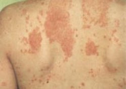 Sedef hastalığı kaderiniz mi