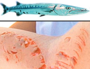 Balık kızı ısırdı