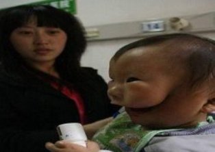 İki yüzlü bebek ameliyat olacak