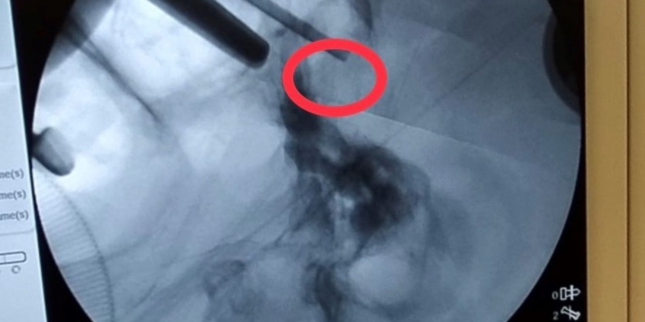 Hastanın beyindeki tümörü burun deliğinden çıkardılar