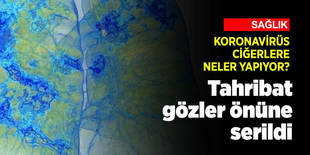 Koronavirüsün ciğerlere yaptığı tahribat gözler önüne serildi