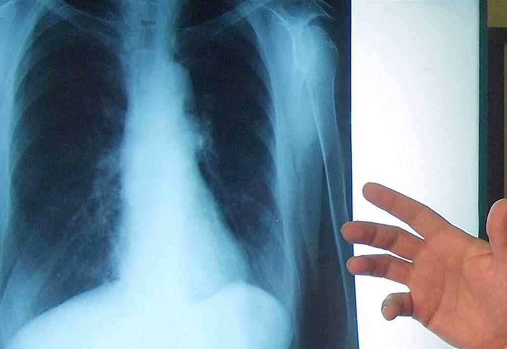 Kanserin belirtileri neler? Kendi kendinize tespit edebilirsiniz