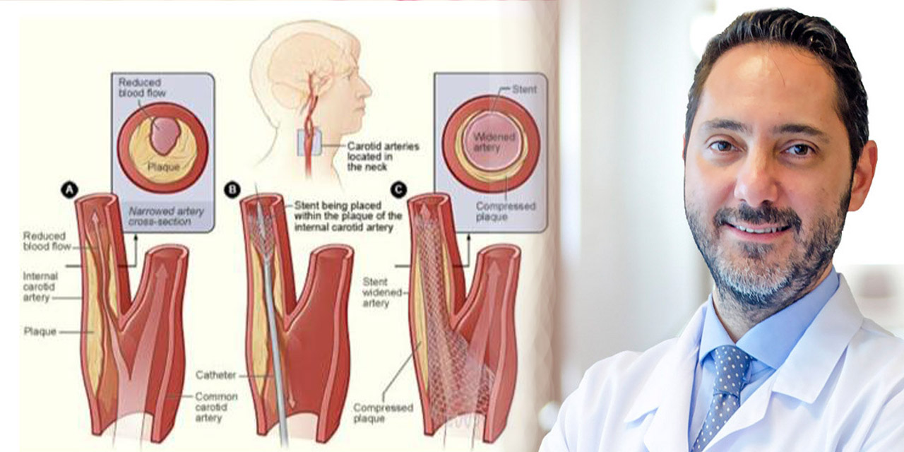 İnme neden olur? Nasıl tedavi edilir? Ailede inme öyküsü varsa risk altındasınız
