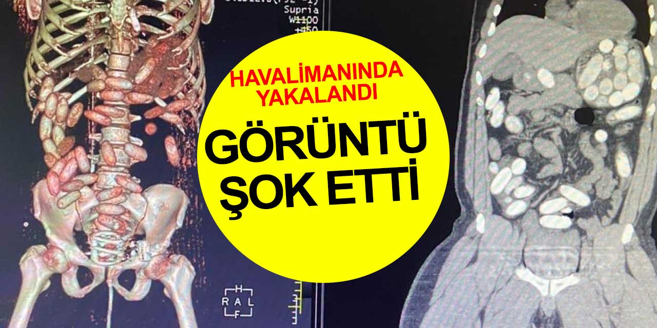 Uyuşturucu ticareti yapan yutucular röntgende yakalandı