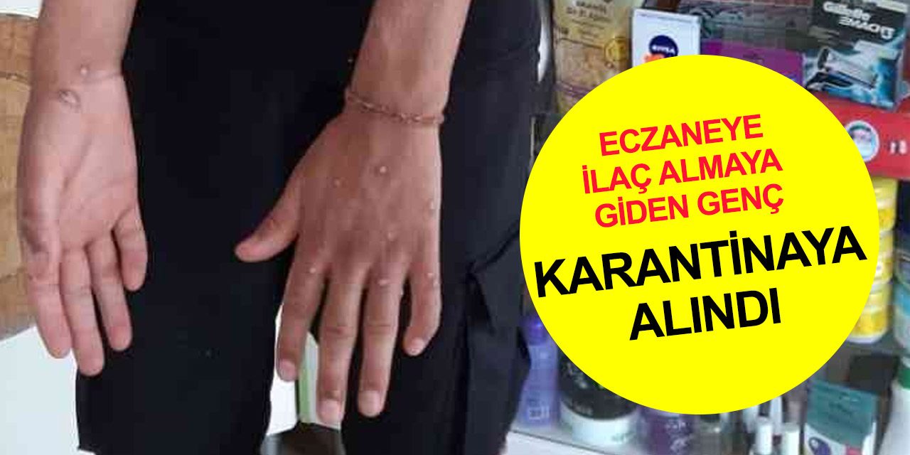 İstanbul'da 'maymun çiçeği' iddiası! Eczaneye gitti karantinaya alındı