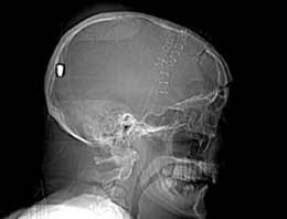 Kafasında mermiyle 5 yıl yaşadı