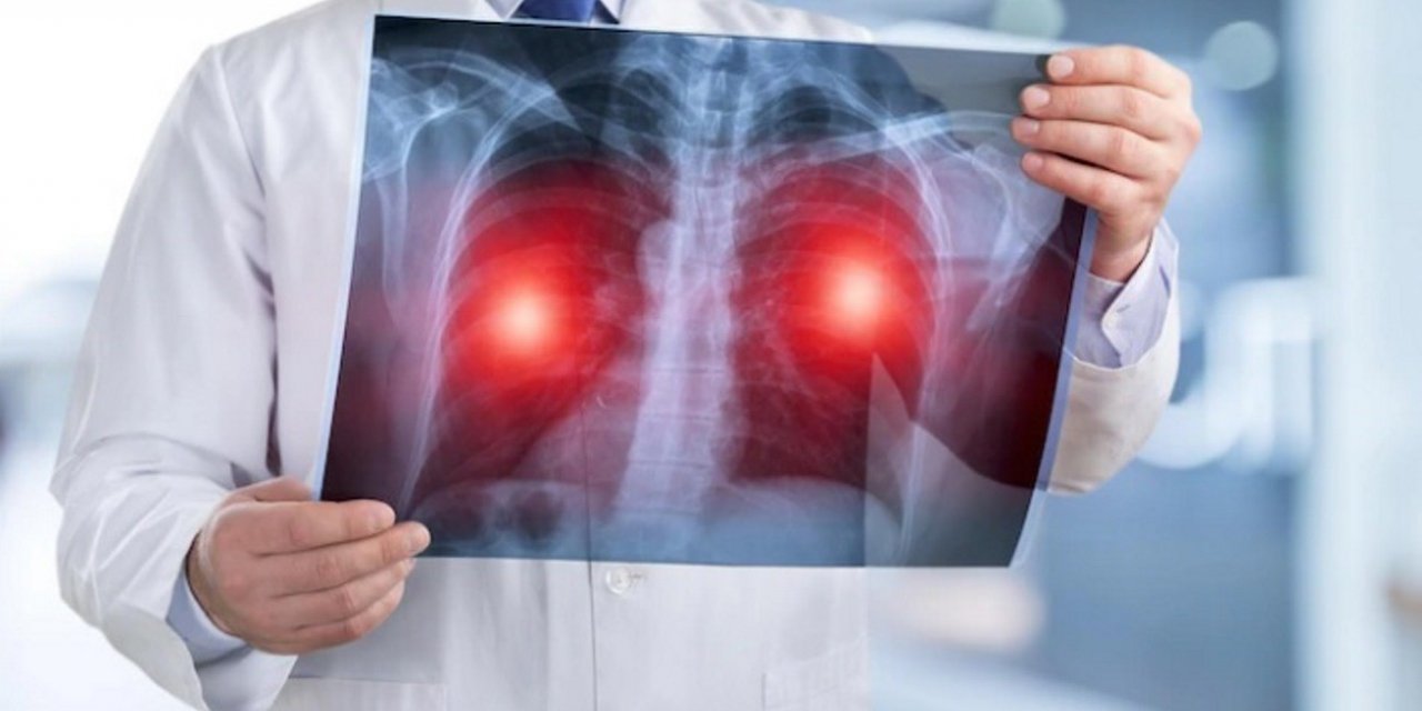 Sigara içenlerde risk 25 kat artıyor